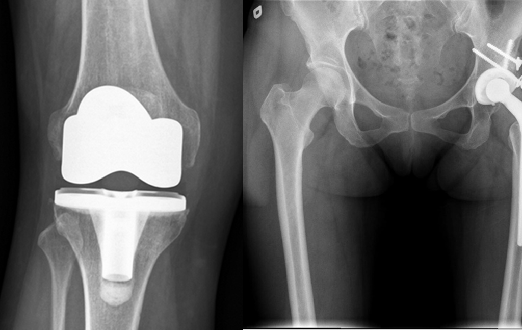 Joint Replacement Surgery Image