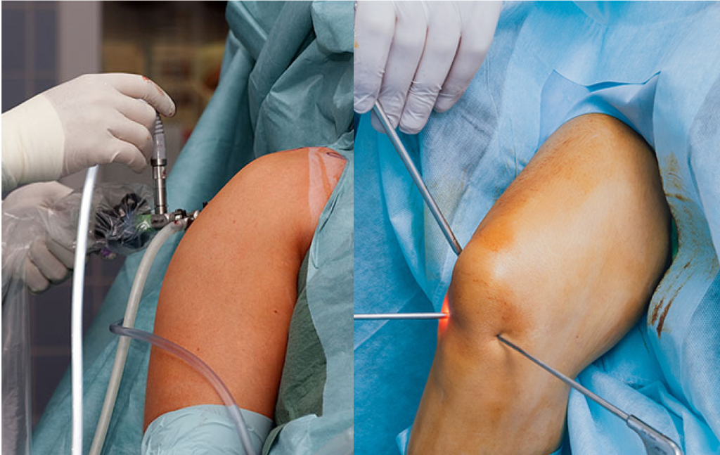 Knee, Shoulders & Hip Replacement Surgery